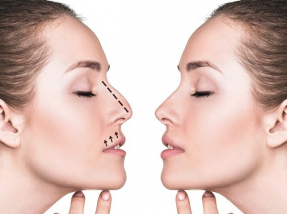 gallery/rinoplastia web